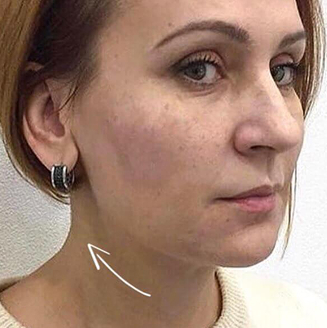 обличчя після процедури